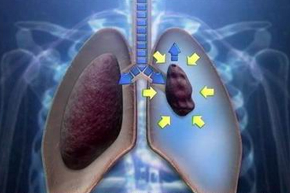 抽电子烟会导致气胸吗？医生这样说