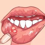 口腔溃疡能抽电子烟吗？